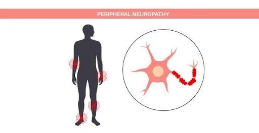 Peripheral Neuropathy (Nerve Damage)