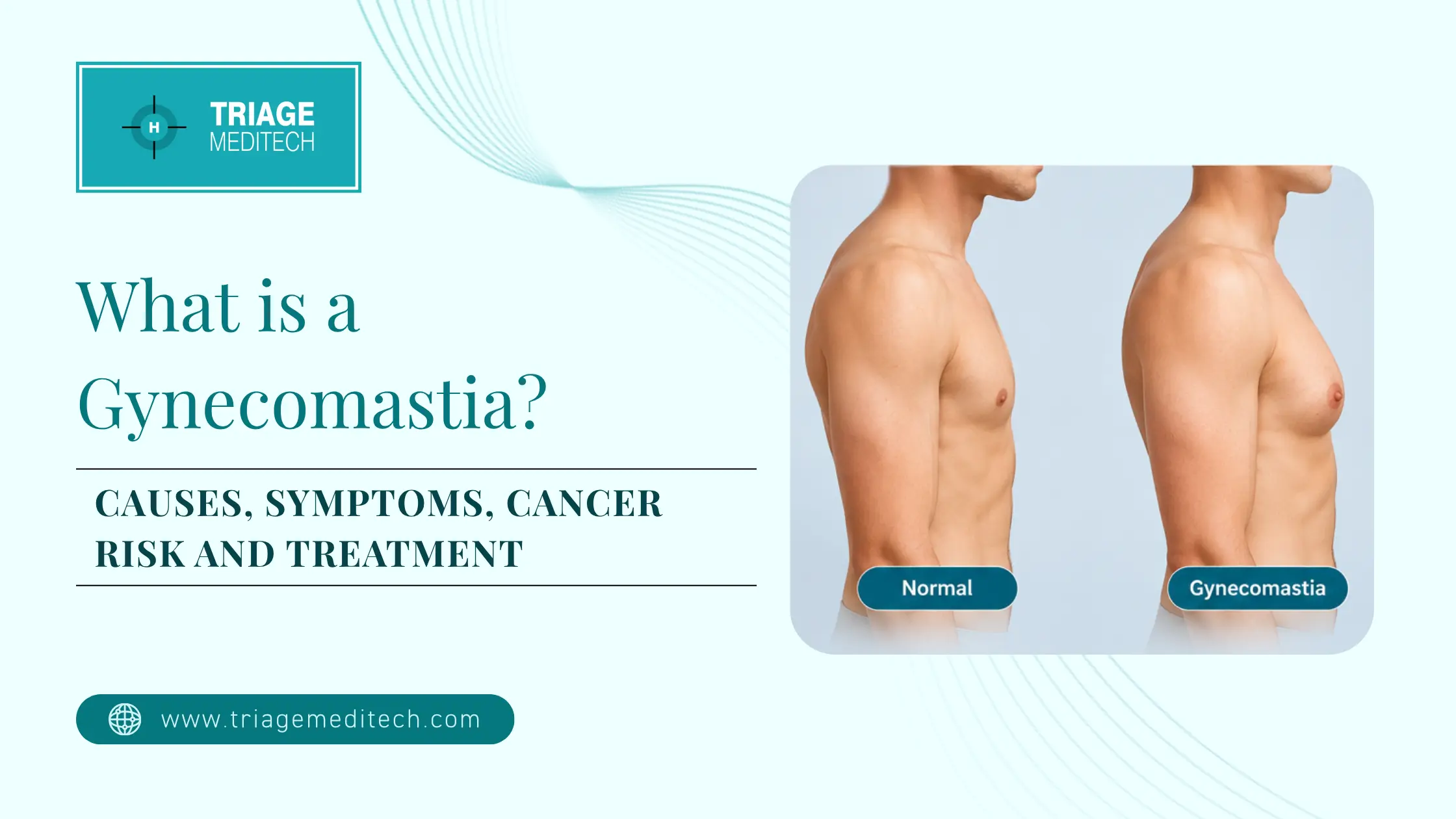 What is Gynecomastia What is Gynecomastia