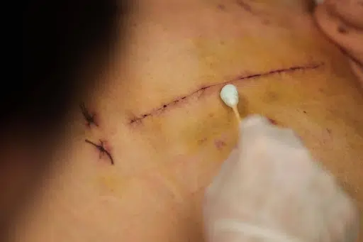 Why Wound Care Matters After Heart Surgery Why Important Wound Care After Heart Surgery