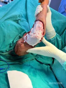 Rapiderm™ matrix being laid over the debrided forearm wound.