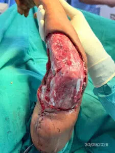 Application of Rapiderm™ - 2