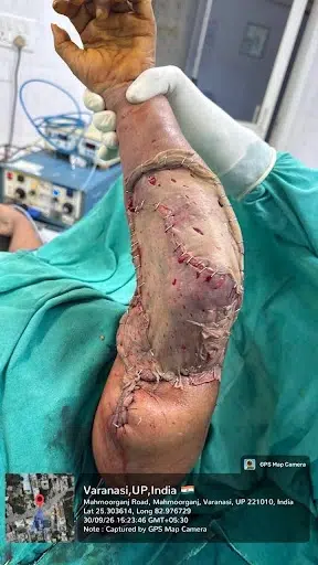 Skin Graft inset and fixation