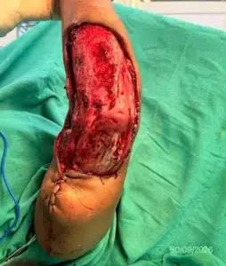 Preparation and debridement