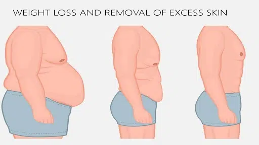 weight loss excess skin body contouring weight loss excess skin Post-Bariatric Body Contouring