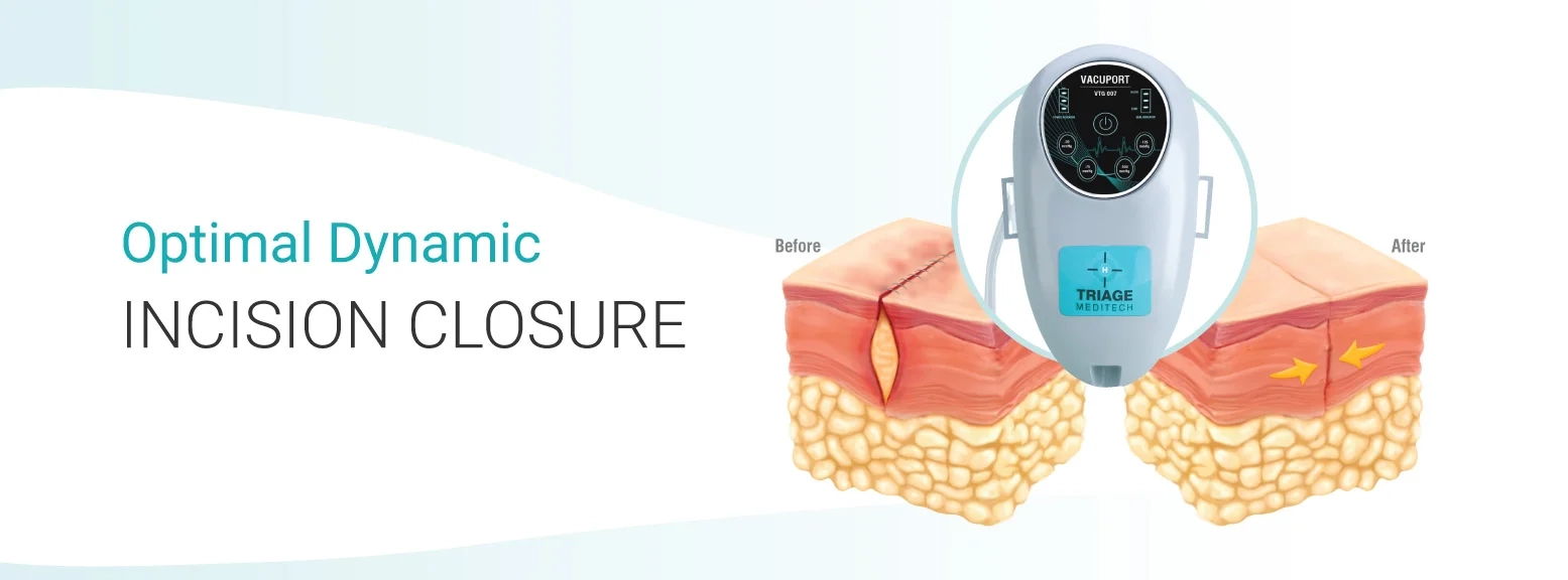 optimal dynamic incision closure